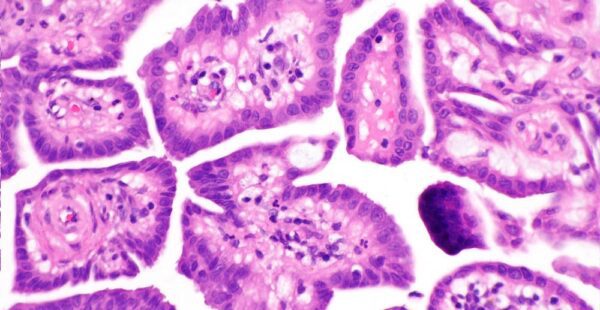 Papillary mesothelioma cells under a microscope